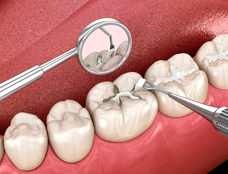 Restore Strength and Protect Your Smile