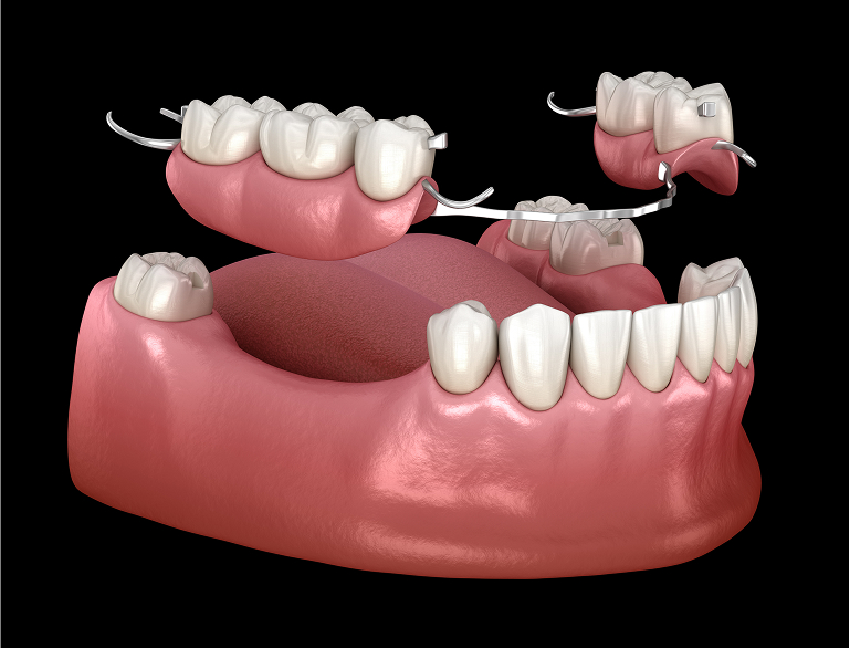 Restore Your Smile and Confidence