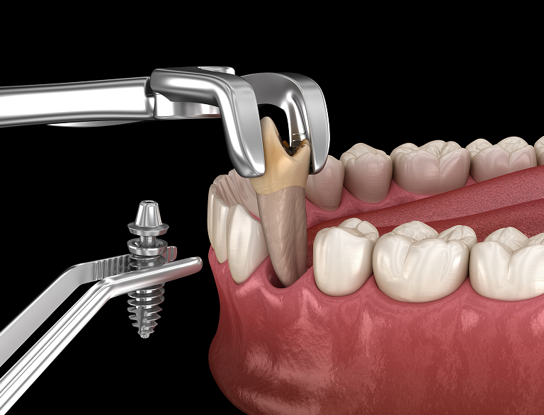 Gentle Care When a Tooth Must Be Removed