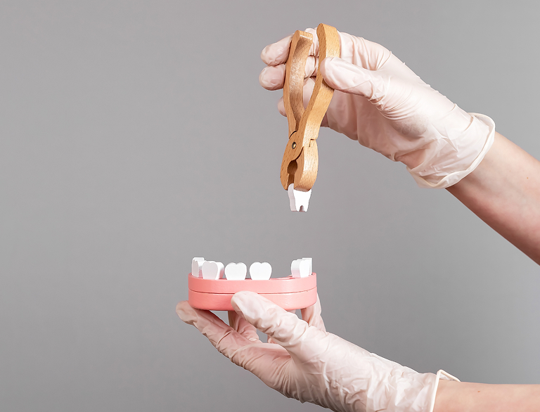 Why Tooth Extractions May Be Needed
